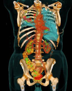 PETCT_mCT_TorsoFusion